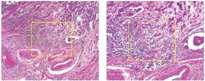 A computational classification method of breast cancer images using the VGGNet model
